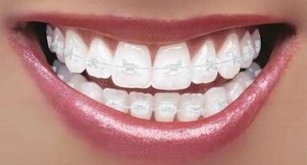 aparelho dentário transparente