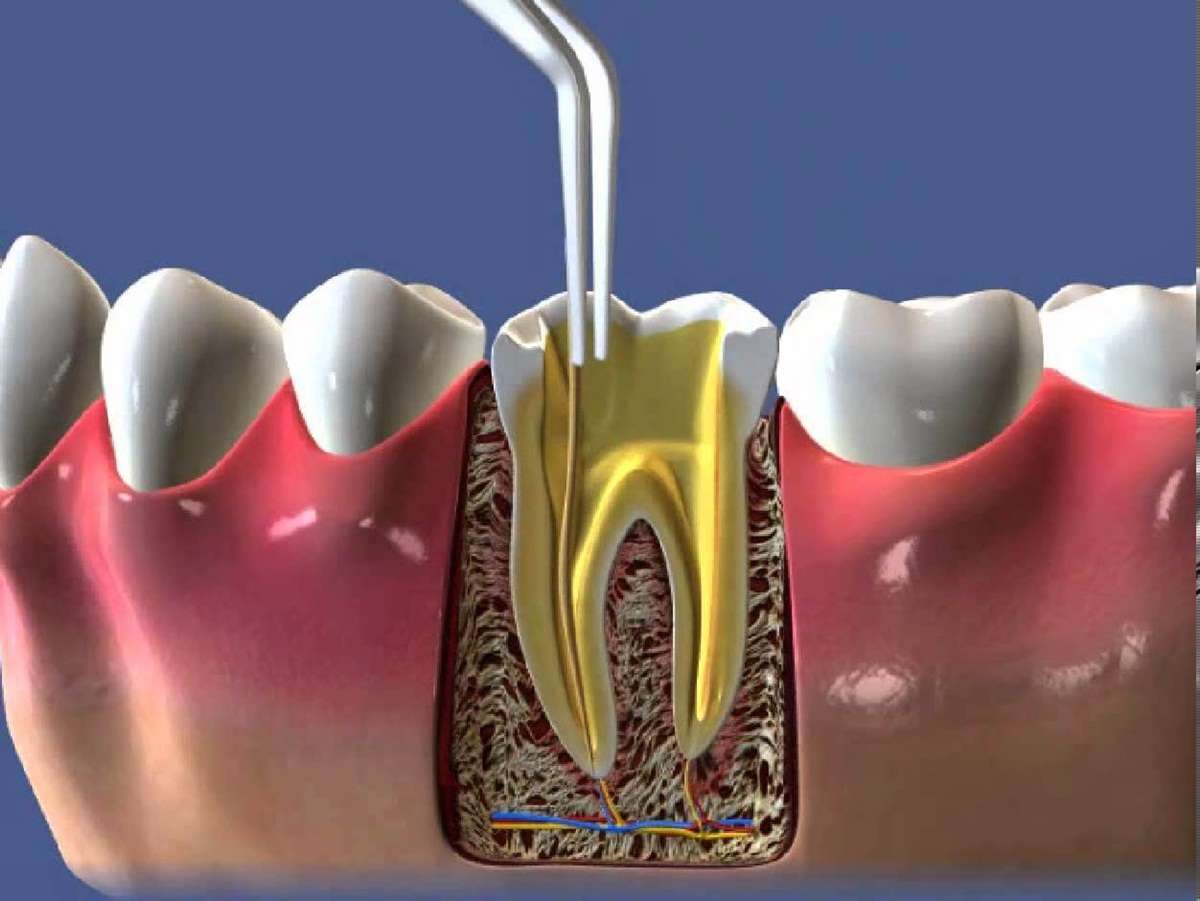 canal de dente inflamado