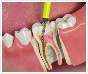 canal de dente inflamado