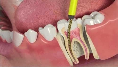 canal dente aberto