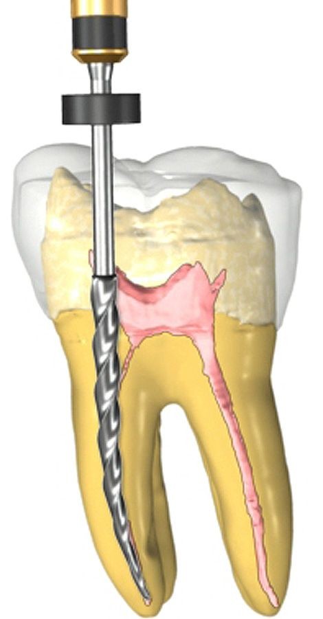 canal dentista