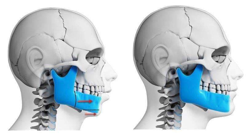 cirurgia bucomaxilofacial