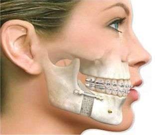 cirurgia crânio maxilo facial