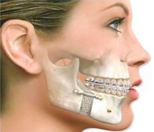 Cirurgia de bucomaxilo