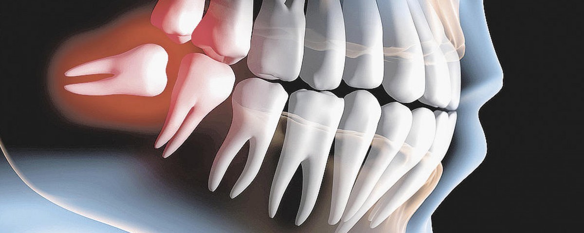 cirurgia de dente incluso