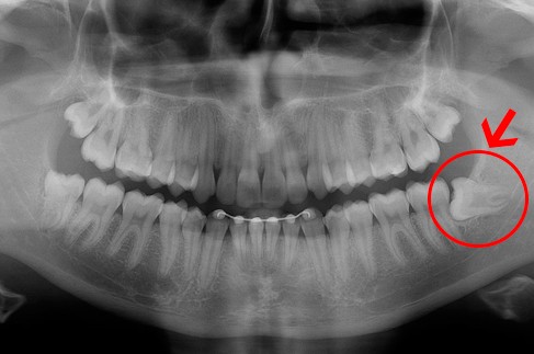 cirurgia de extração de dente siso