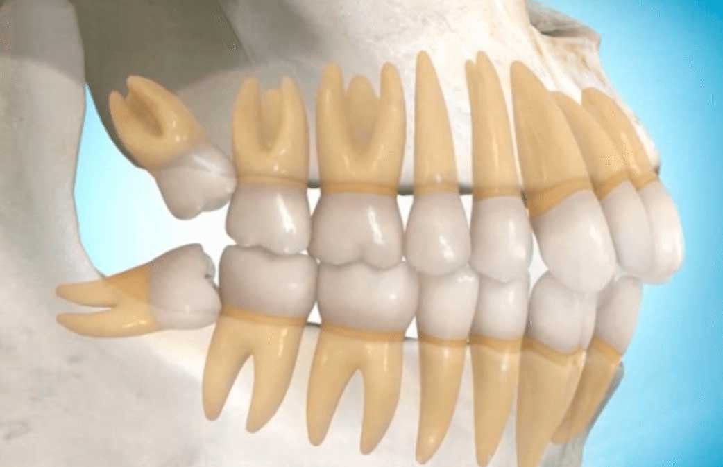 Cirurgia de extração de siso incluso