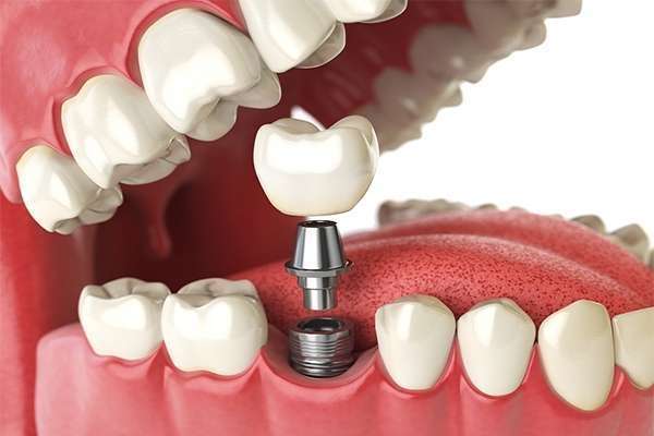 cirurgia de implante de dente