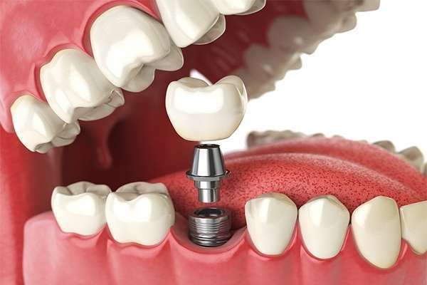 Cirurgia de implante de dente