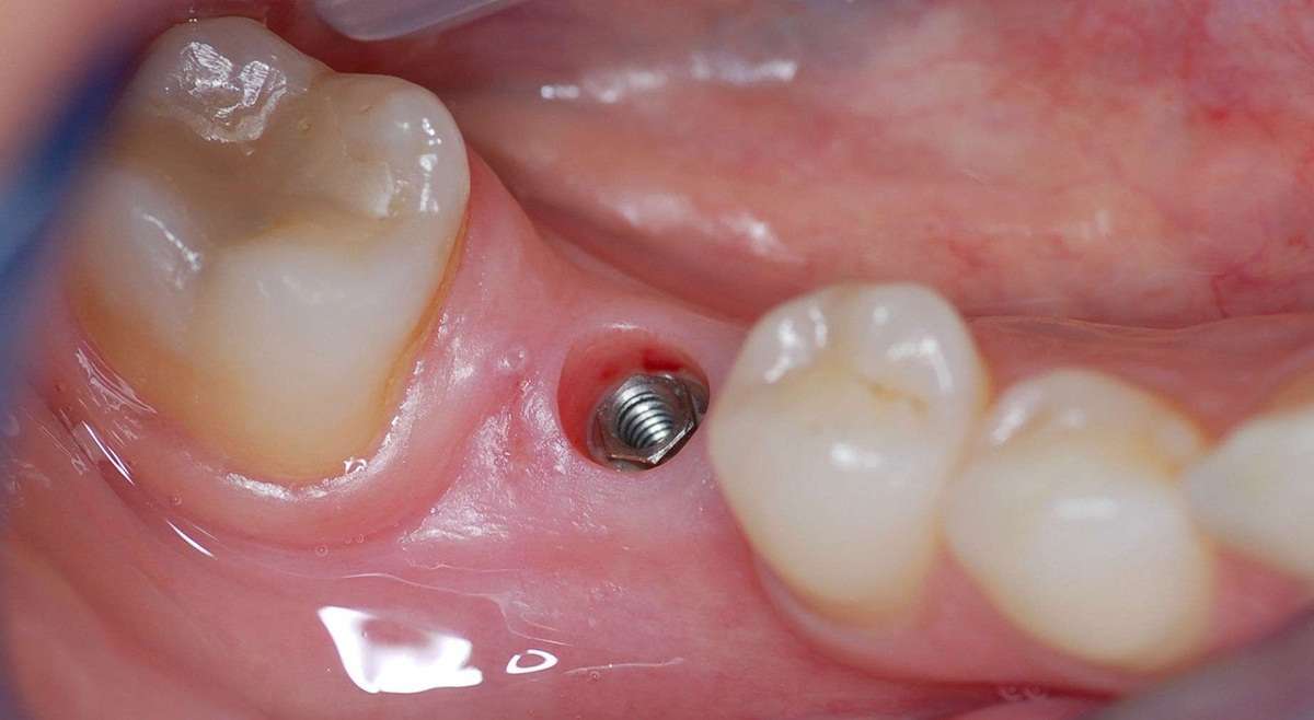 cirurgia de implante de dente
