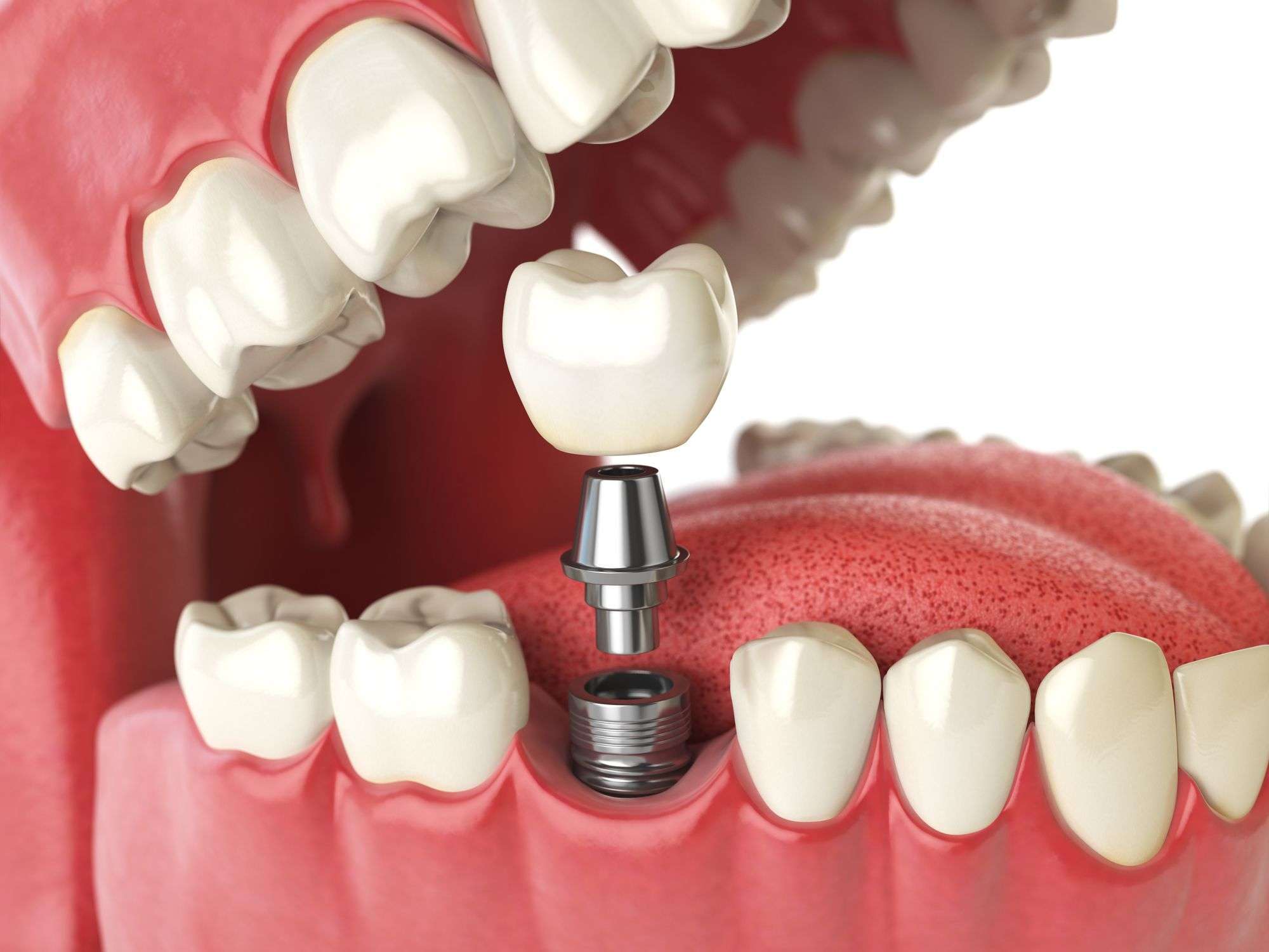 cirurgia de implante dentário