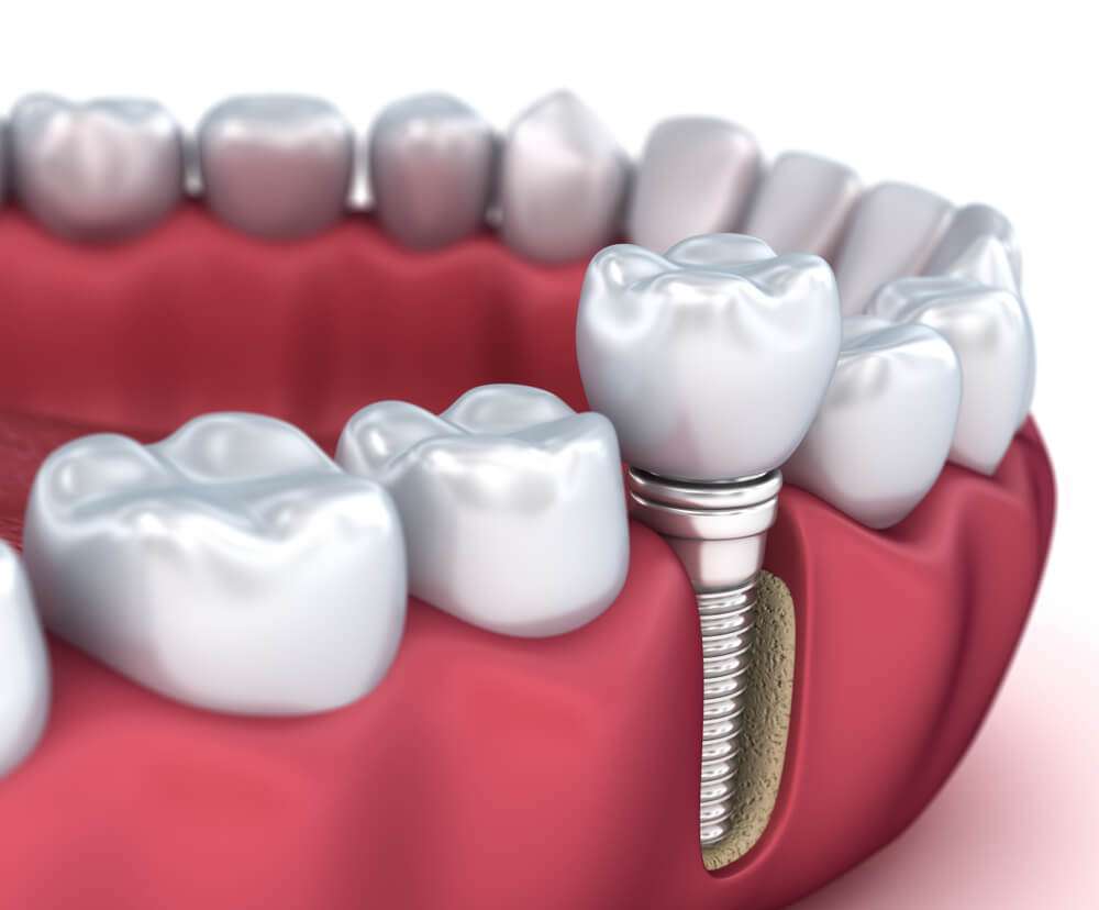 cirurgia de implante dentário
