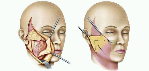 cirurgia de lifting facial