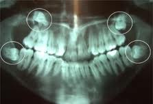 Cirurgia de siso incluso