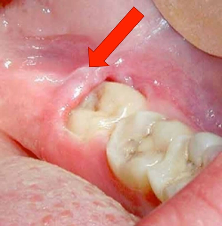 Cirurgia dente siso