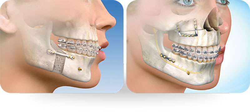 Cirurgia do maxilar inferior