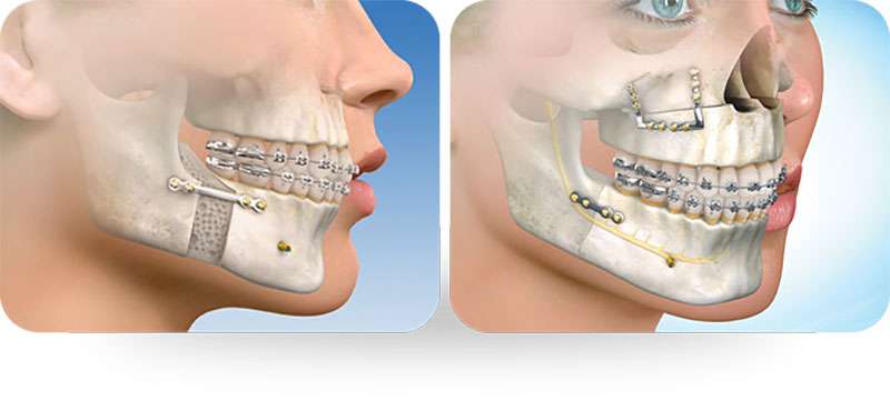 cirurgia do maxilar inferior