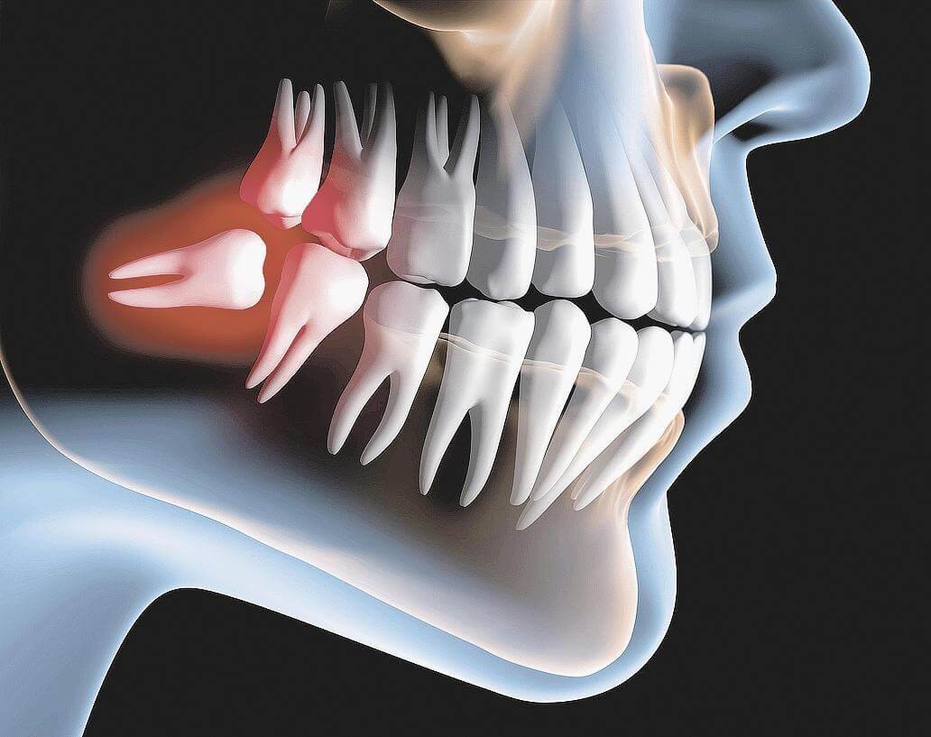 Cirurgia do siso