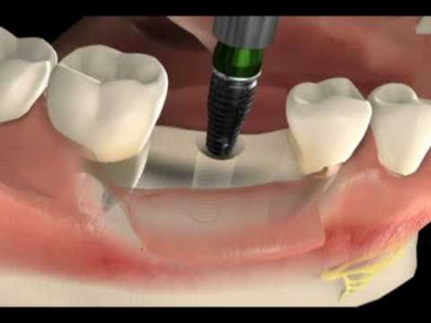 cirurgia implante dental