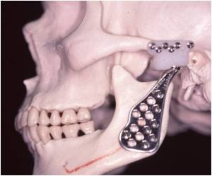 Cirurgia maxilar atm