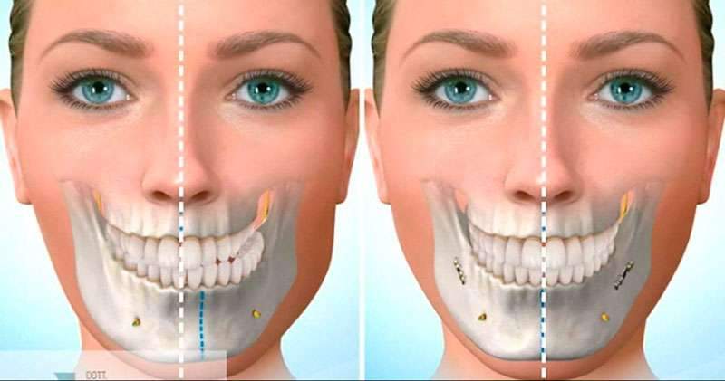 Cirurgia maxilo facial