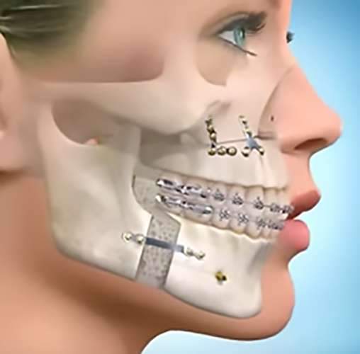 cirurgia maxilofacial