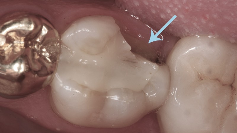 cirurgia no dente