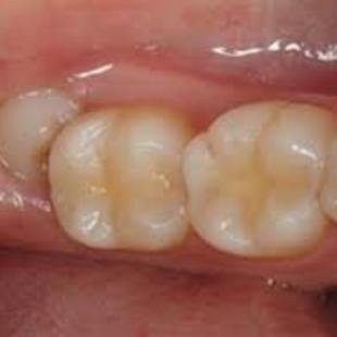 cirurgia no dente