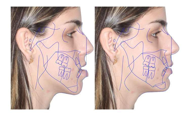 cirurgia ortognática quanto custa