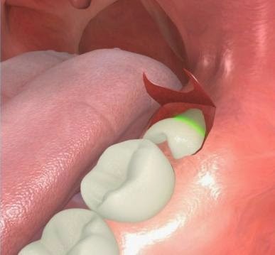 Cirurgia para arrancar o siso