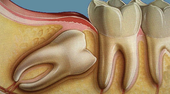 Cirurgia para tirar o siso