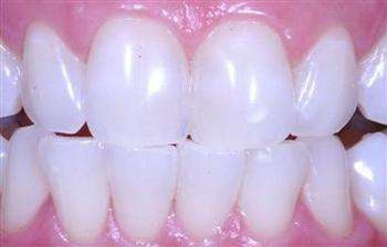 clareamento a laser nos dentes