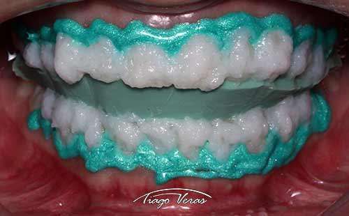 clareamento de dente a laser