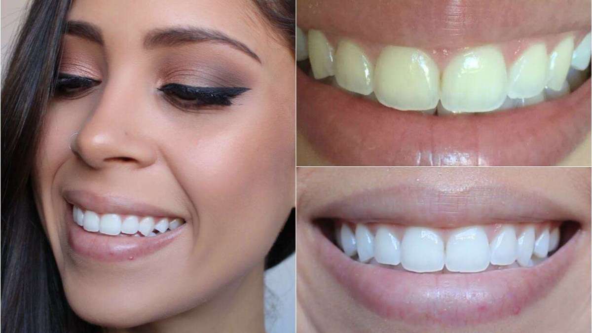 Clareamento dental consultório