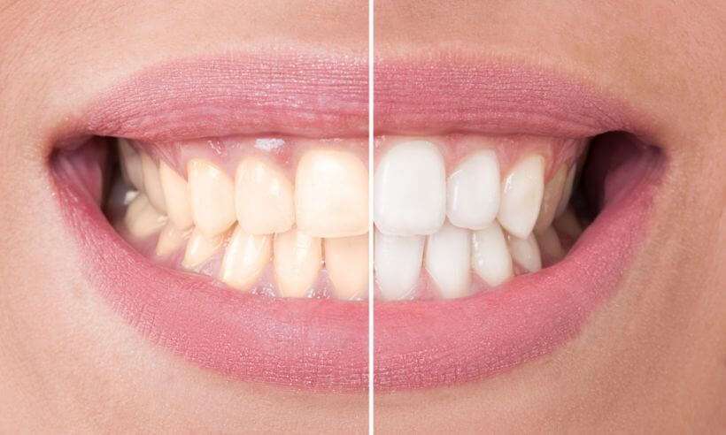 Clareamento dental no dentista