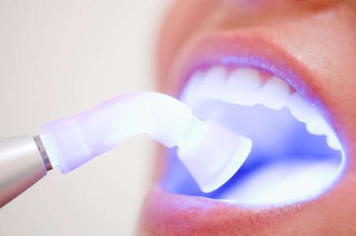 clareamento dental no dentista