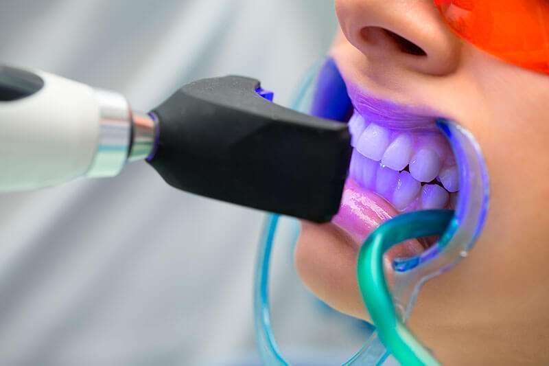 clareamento dental profissional