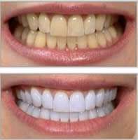 clareamento dental profissional