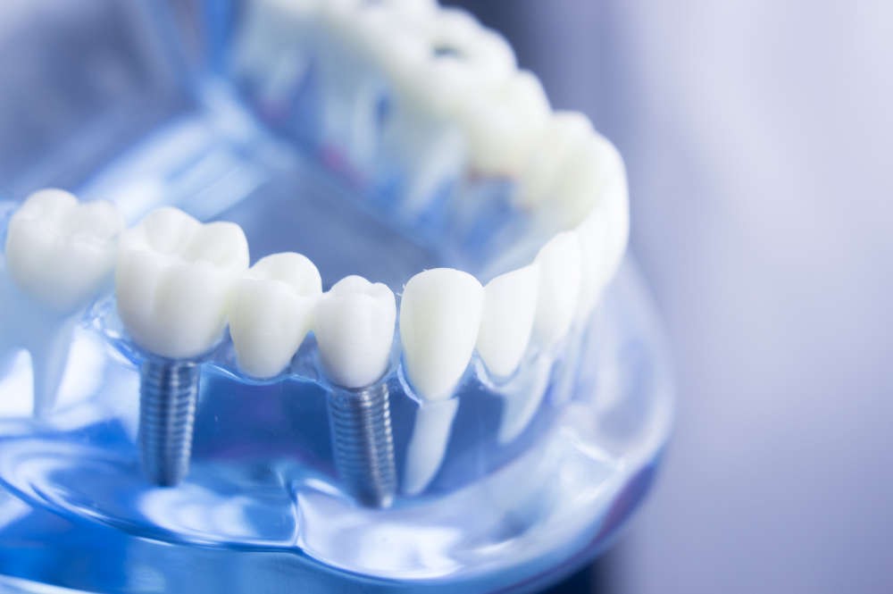 Clinicas dentarias de implantes