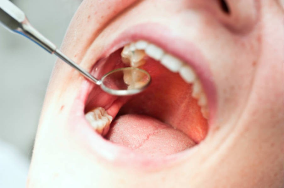 dente canal aberto doendo