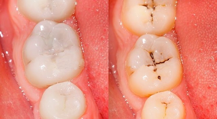 Dente com cárie profunda - Consulta Ideal