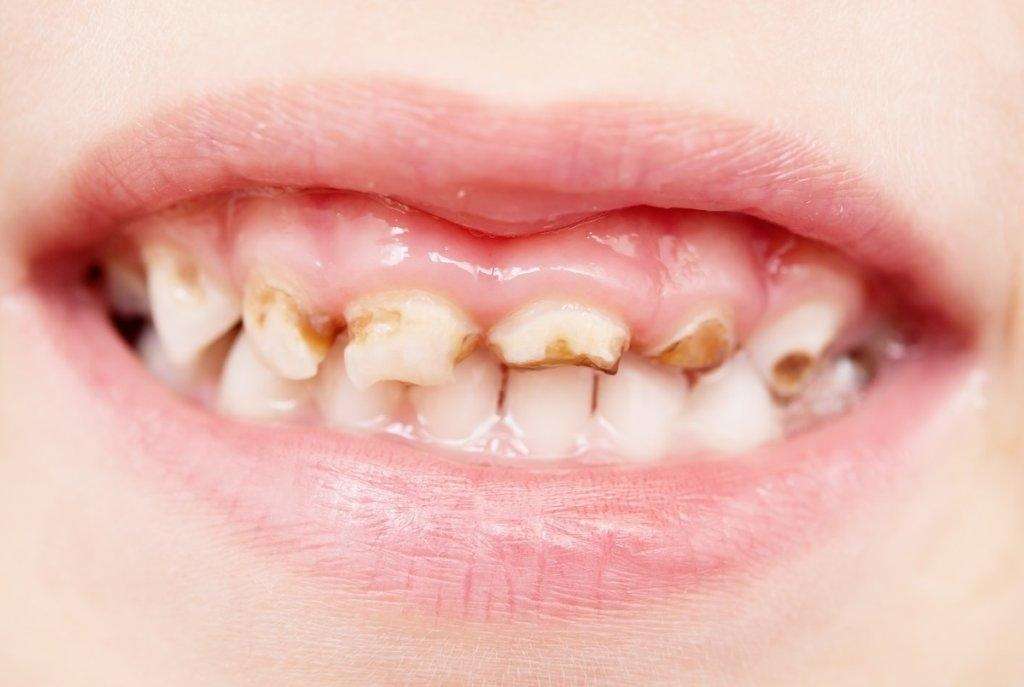 Dentes cariados