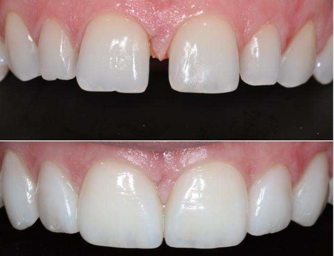 Dentes com lente de contato