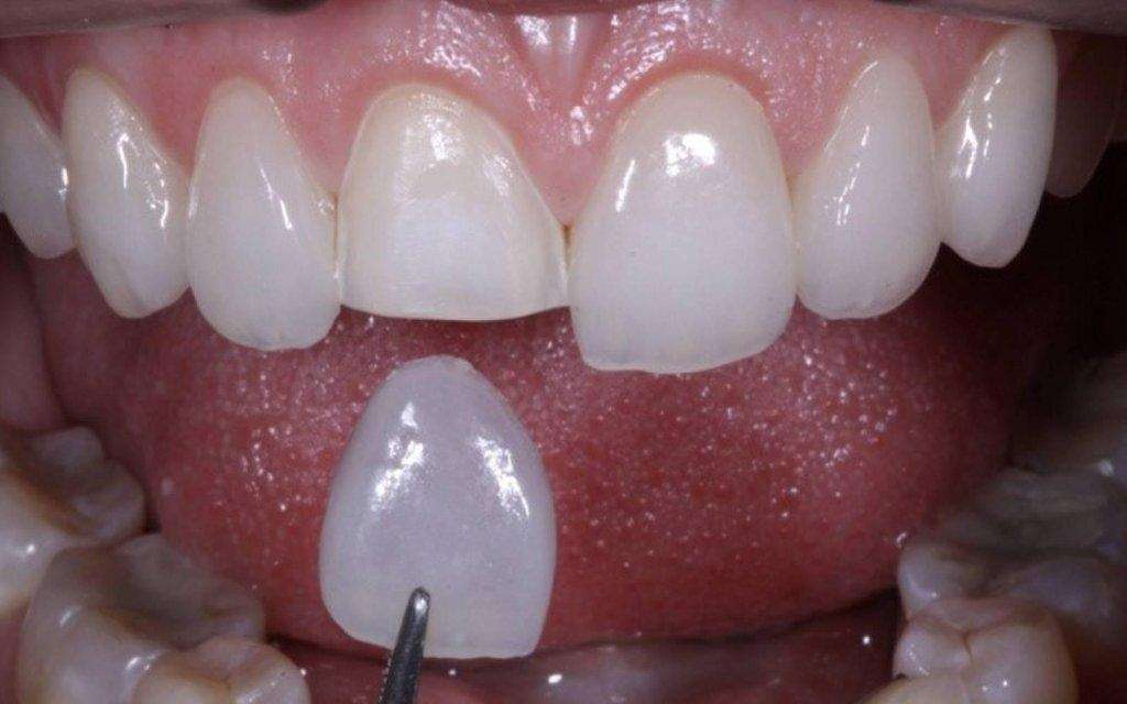 dentes facetas de porcelana