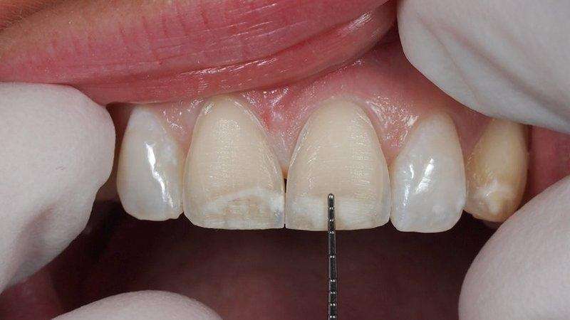 dentes facetas de porcelana