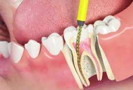 dor de dente canal
