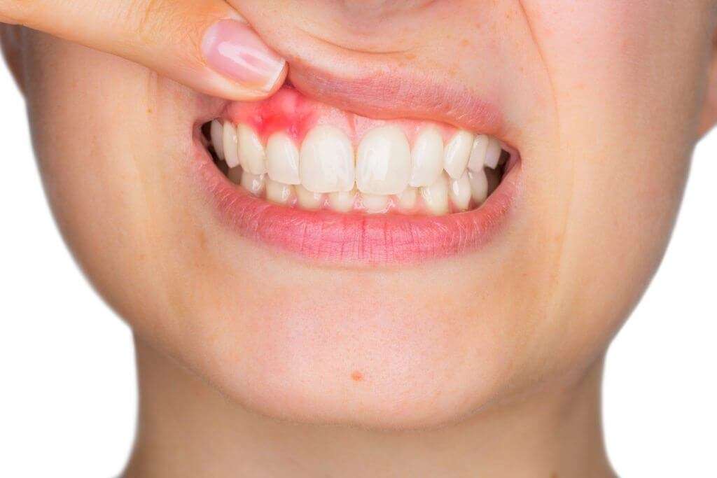 Dor dente canal inflamado