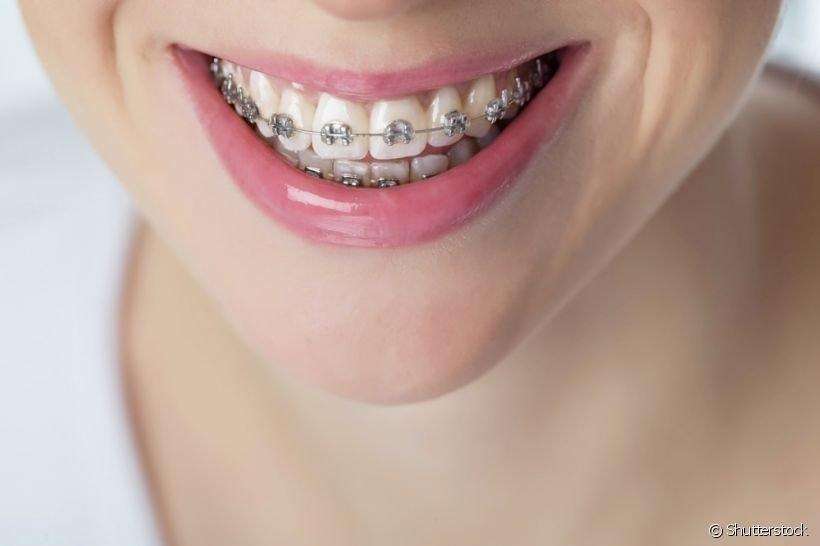 Especialista em aparelho dentário