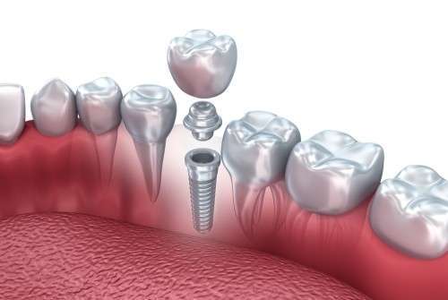 especialista em implante dentário