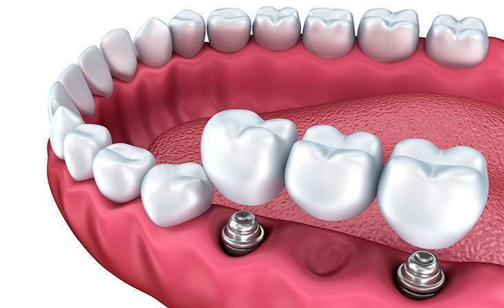 Implante de dente quanto custa